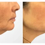 Thread Lift in Dubai: The Best Way to Achieve a Non-Invasive Face Lift