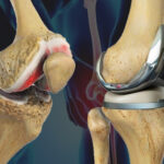 Total Knee Replacement