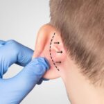 Ear Reshaping in Dubai