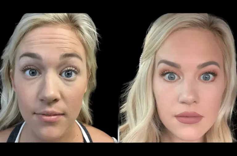 H3-Botox