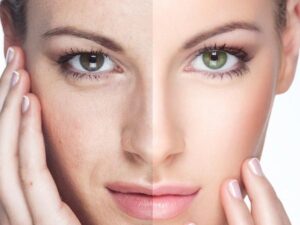 Skin Whitening Solutions Without Damaging Your Skin