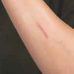 Surgical Scar Revision Trusted Solution for Scars