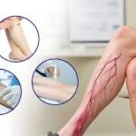 Varicose Vein Treatment in pune