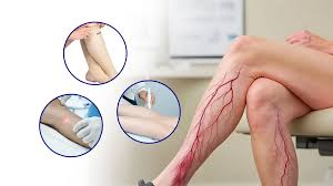 Varicose Vein Treatment in pune