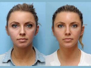 Achieve Youthful Glow with Thread Lift from the Best Doctors in Dubai