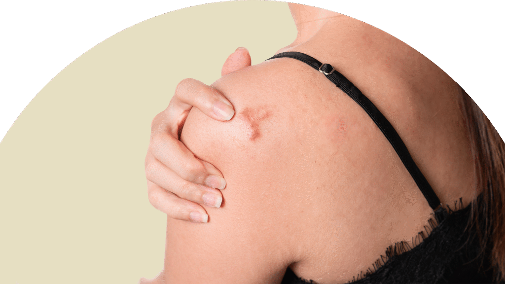 Achieve Natural Looking Skin with Surgical Scar Revision