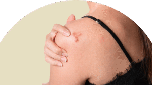 Achieve Natural Looking Skin with Surgical Scar Revision