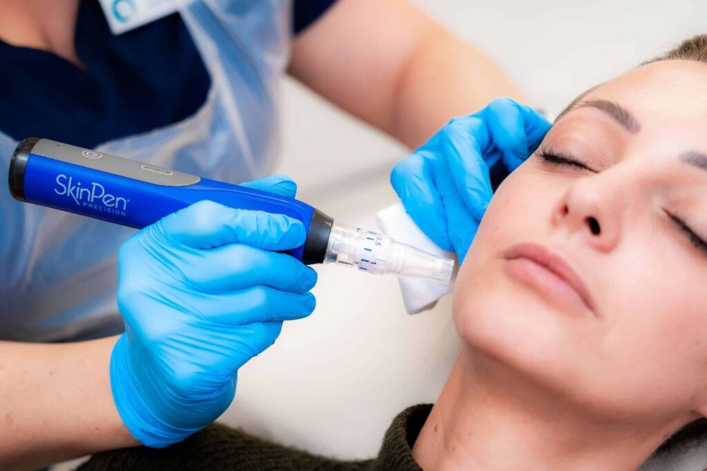 Advanced Laser Treatments for Acne Scars
