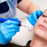 Advanced Laser Treatments for Acne Scars