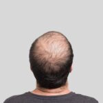 G Cell Hair Treatment in Dubai