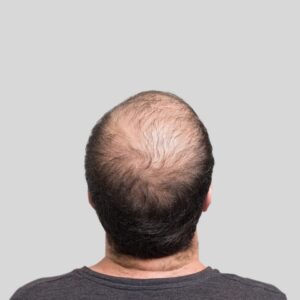 G Cell Hair Treatment in Dubai