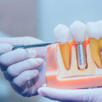 Dental Implant Surgeon Tips for Faster Healing