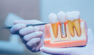 Dental Implant Surgeon Tips for Faster Healing