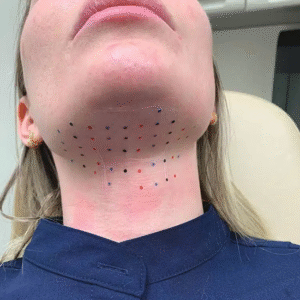 Double Chin Removal Achieve a Slimmer Face with Ease