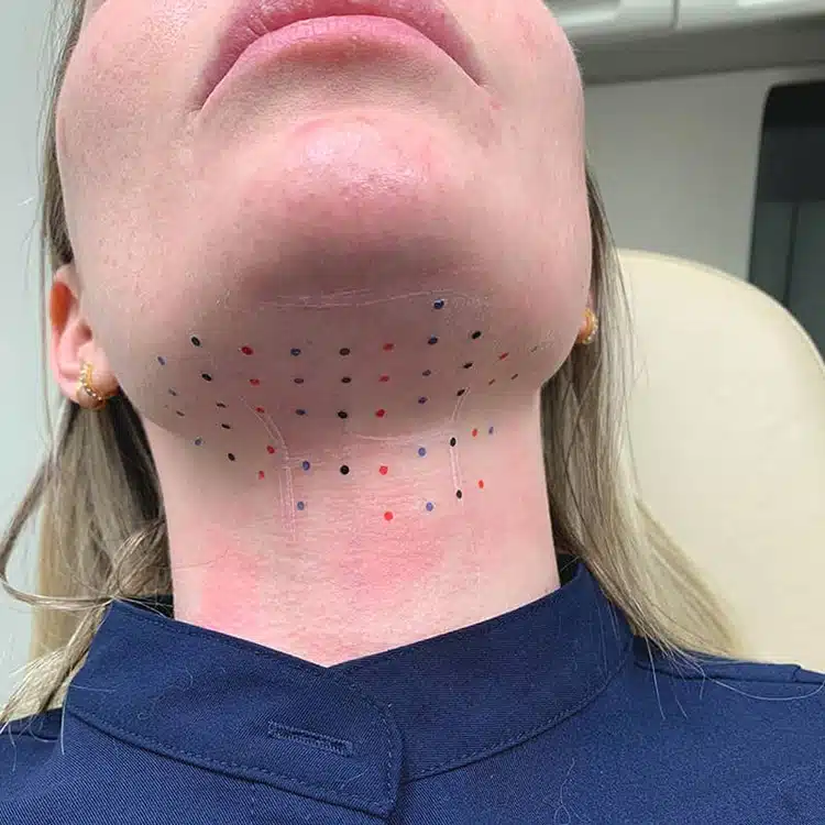 Double Chin Removal Achieve a Slimmer Face with Ease