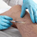 Expert Sclerotherapy for Varicose Veins
