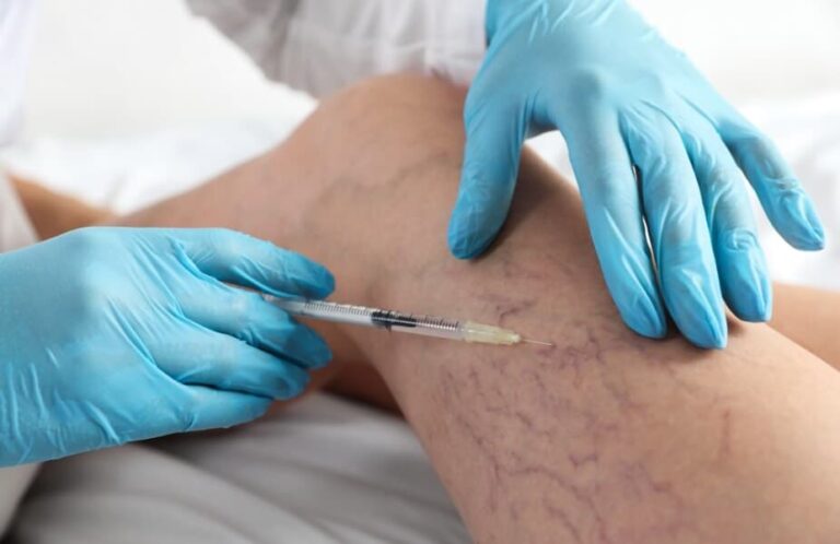 Expert Sclerotherapy for Varicose Veins