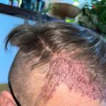 FUE Hair Transplant Say Goodbye to Hair Loss