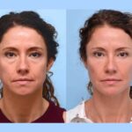 The Best Aesthetic Clinic in Dubai Delivers Flawless Contouring Via Innovative Thread Lift