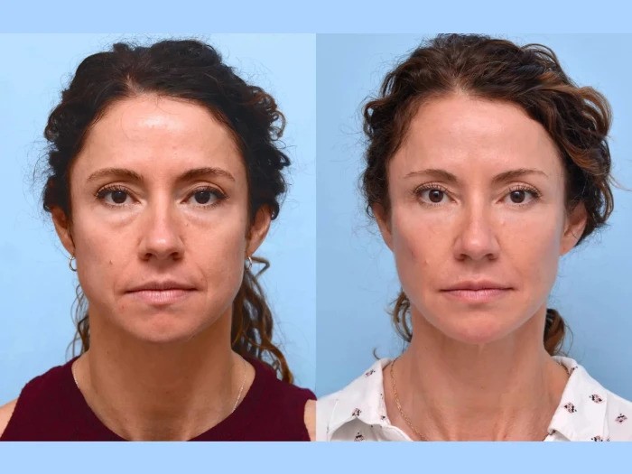 The Best Aesthetic Clinic in Dubai Delivers Flawless Contouring Via Innovative Thread Lift