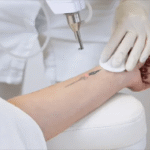 Laser Tattoo Removal Achieve Smooth, Tattoo‑Free Skin