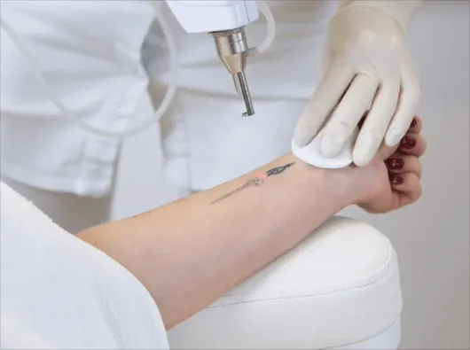 Laser Tattoo Removal Achieve Smooth, Tattoo‑Free Skin