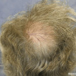 Non-Invasive Crown Hair Transplant for Natural Results
