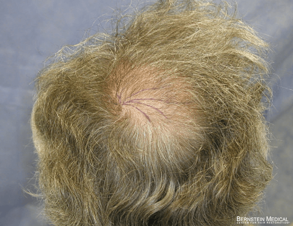 Non-Invasive Crown Hair Transplant for Natural Results