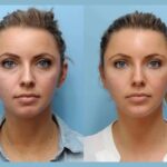 Best Aesthetic Clinic in Dubai Offers Thread Lift Treatments for Youthful Glowing Skin