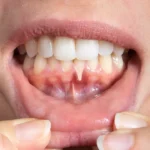 gingivitis-gum-health
