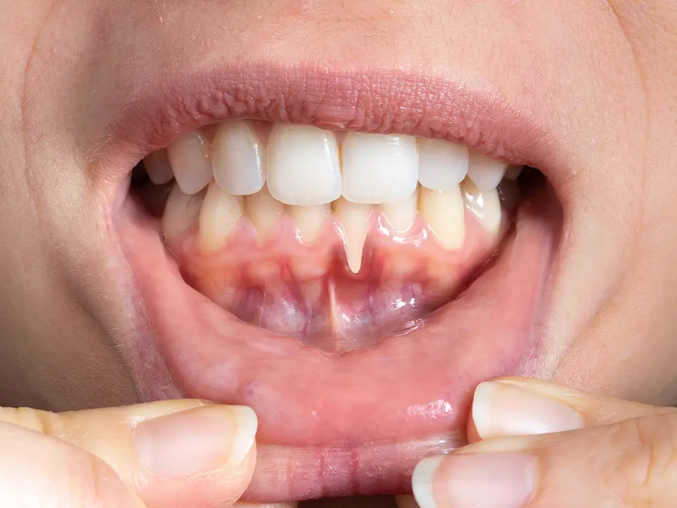 gingivitis-gum-health