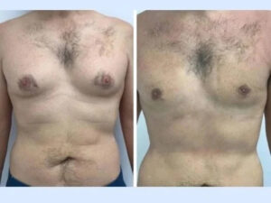 gynecomastia surgery in Dubai