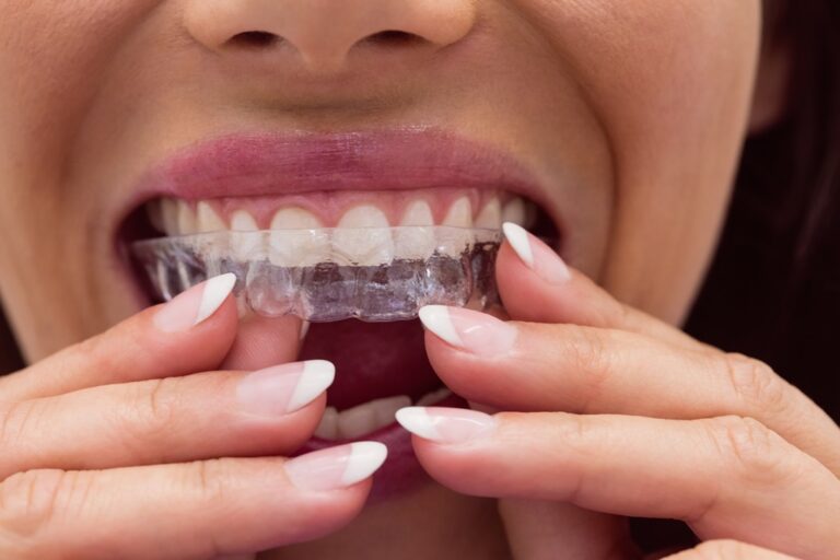 teeth straightening