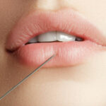 Transform Your Look with Subtle Russian Lip Fillers