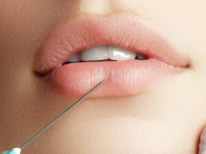 Transform Your Look with Subtle Russian Lip Fillers
