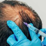 Advanced Hair Fillers Therapy for Healthy Hair