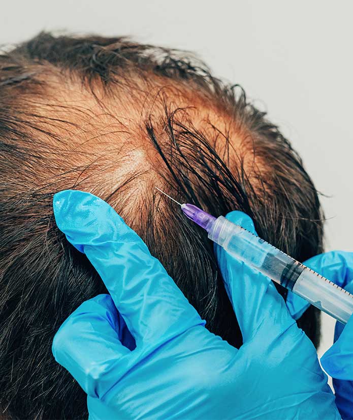Advanced Hair Fillers Therapy for Healthy Hair