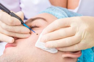 Advanced Mole Removal Treatments