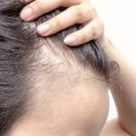 Alopecia Market