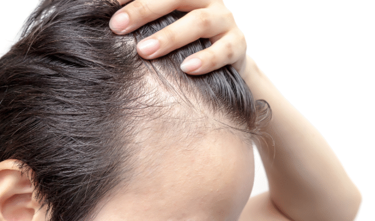 Alopecia Market