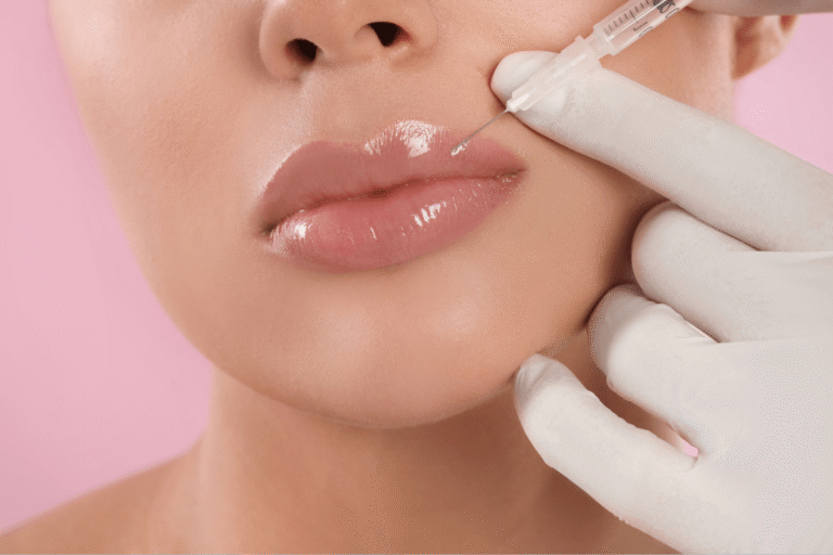 Russian Lip Fillers in Dubai