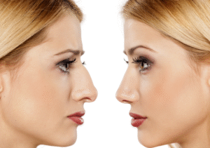 Dubai Rhinoplasty Reviews: Real Experiences