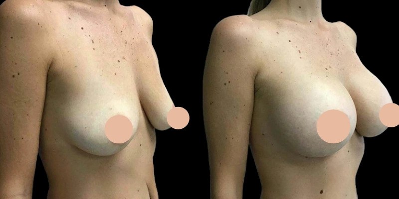 Achieving Natural-Looking Results with the Best Breast Augmentation Surgeon in Dubai