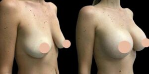 H11-Breast-Augmentation-ezgif.com-webp-to-jpg-converter
