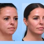 Experience Smooth Firm Skin via Thread Lift from Best Plastic Surgeons in Dubai