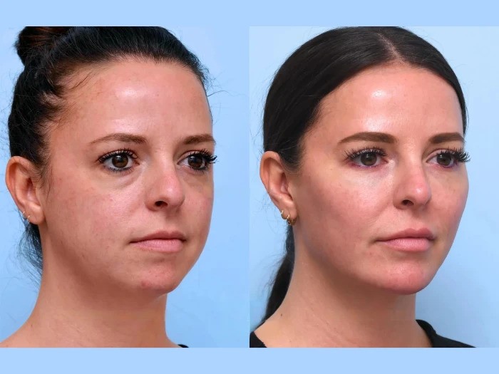 Experience Smooth Firm Skin via Thread Lift from Best Plastic Surgeons in Dubai