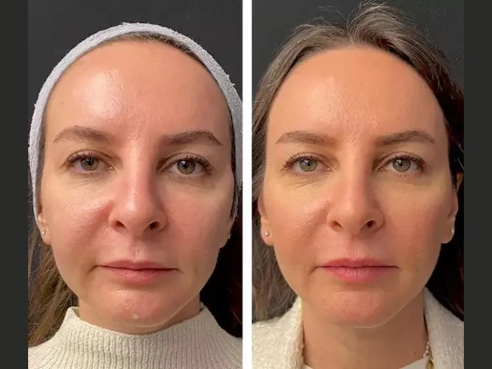 Mesotherapy injection in Dubai