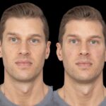Under eye fillers