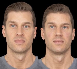 Under eye fillers