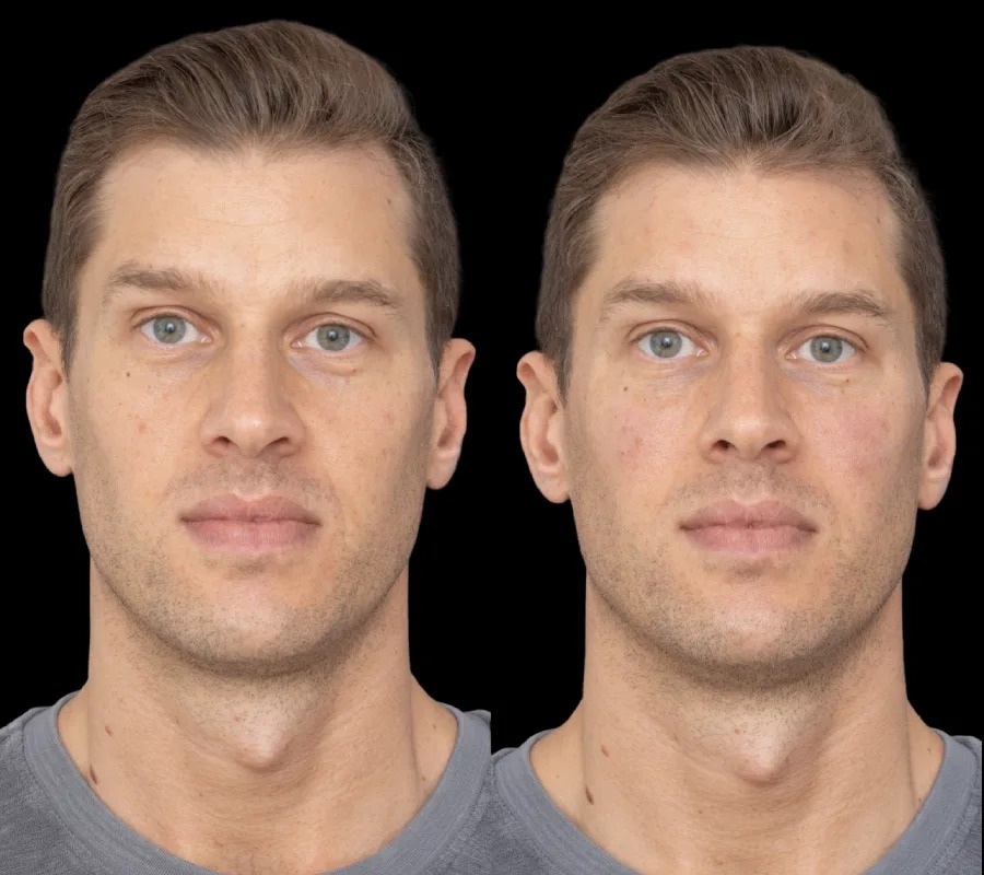 Under eye fillers
